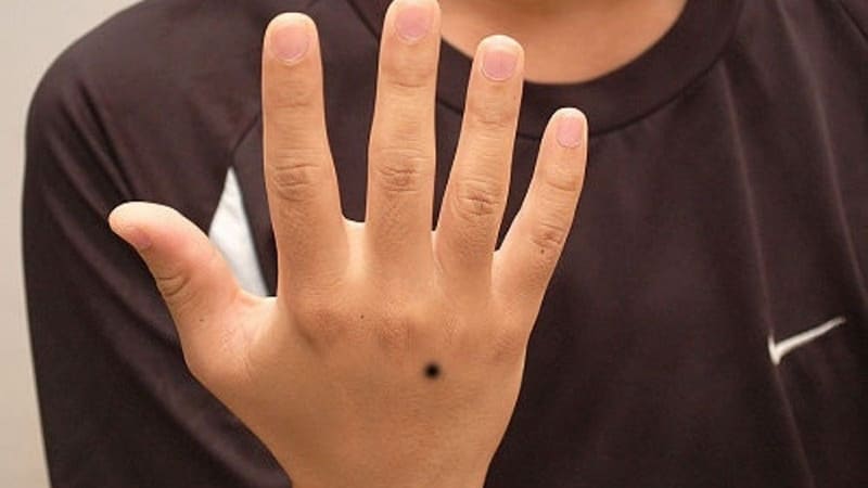 Nốt ruồi ở mu bàn tay có thể tốt hoặc xấu tùy vào vị trí cụ thể