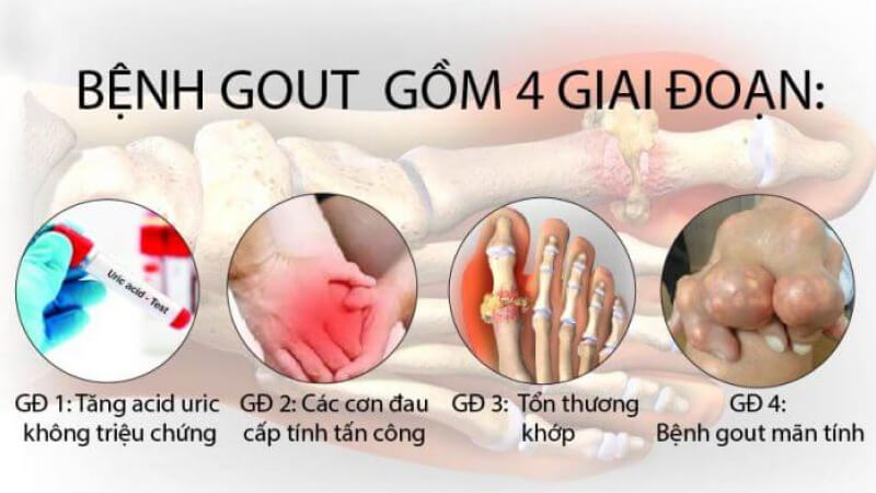 Các giai đoạn của bệnh gout