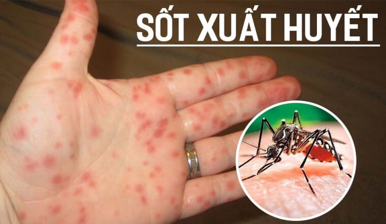 Bị sốt xuất huyết có uống sữa Ensure được không? Lời khuyên từ chuyên gia