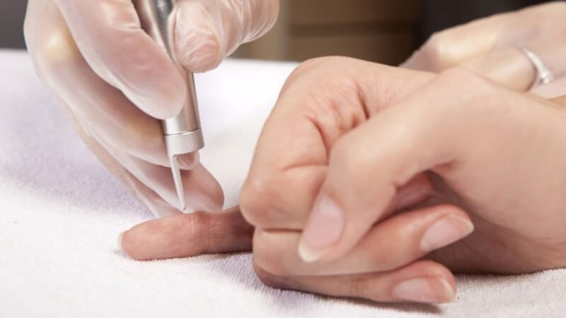 Tẩy nốt ruồi ở ngón tay có thể để lại sẹo