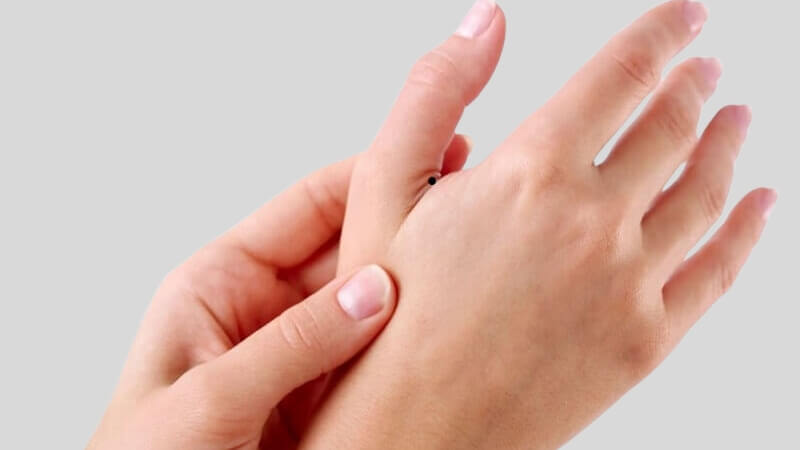 Nốt ruồi ở kẽ ngón tay