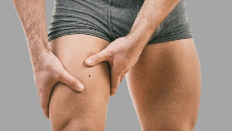 Nốt ruồi ở đùi trước của nam giới