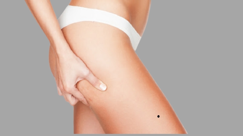 Nốt ruồi ở đùi trước của nữ giới