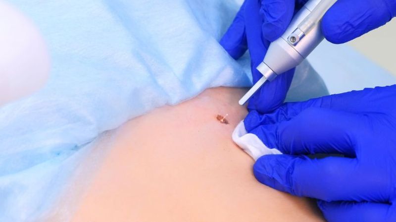 Tùy vào nhu cầu của bản thân là có nên xóa nốt ruồi ở mông không