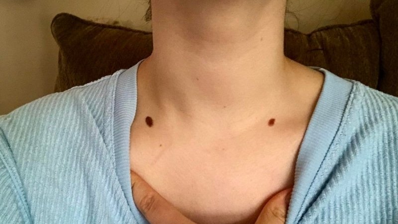 Nốt ruồi to, đậm màu hoặc thay đổi bất thường có thể tiềm ẩn nguy cơ ác tính