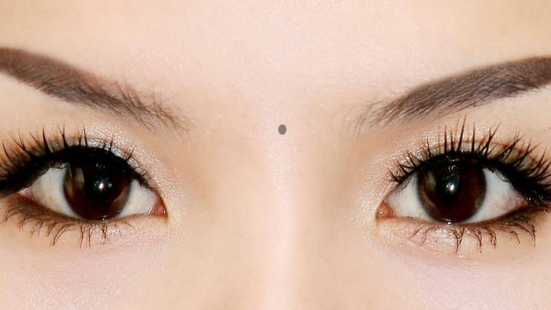 Xóa nốt ruồi ở lông mày nên cân nhắc cả tướng lẫn thẩm mỹ
