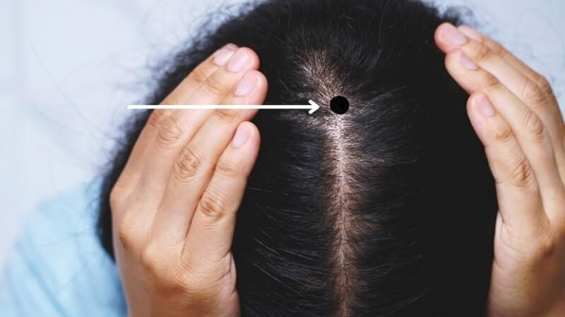 Ý nghĩa chung của nốt ruồi trên đầu trong nhân tướng học