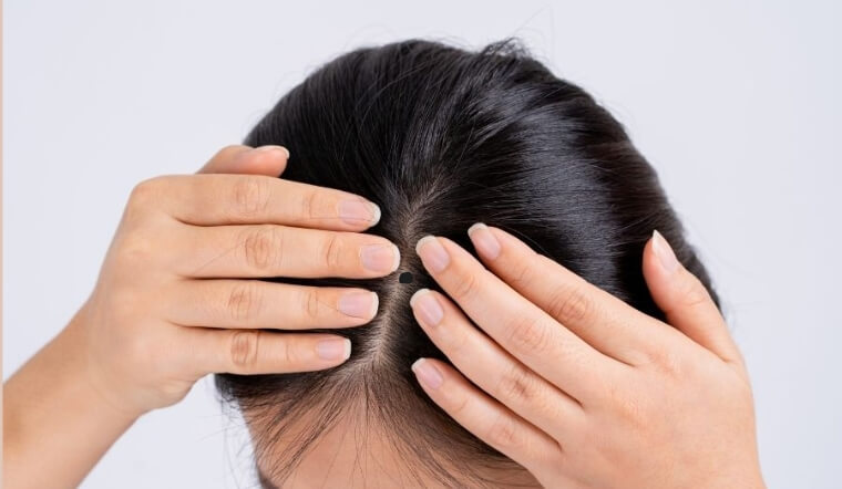 Nốt ruồi trên đầu: Vận mệnh lãnh đạo hay cuộc đời vất vả?