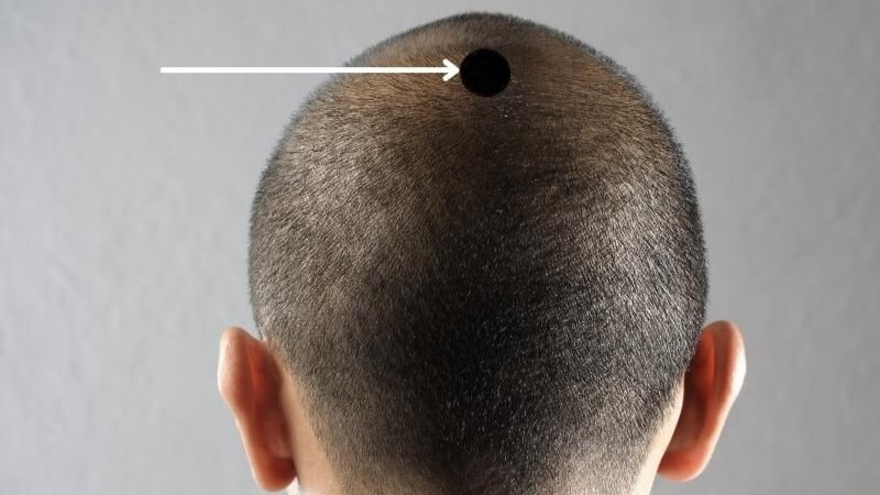 Nốt ruồi trên đỉnh đầu: Có tài "cầm quân", số lãnh đạo