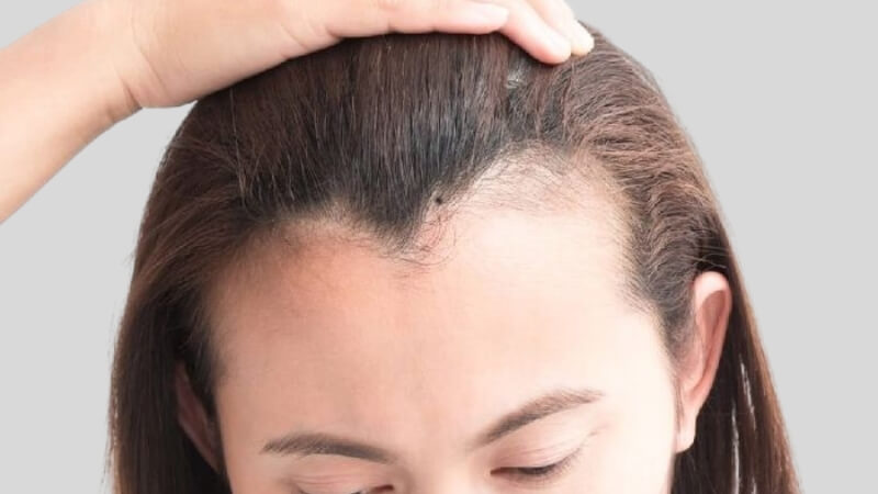 Nốt ruồi ở trán gần chân tóc