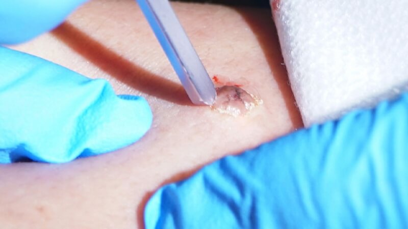 Nên tẩy nốt ruồi ở gót chân nếu nó có dấu hiệu của u ác tính