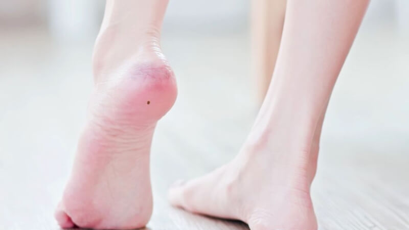 Nốt ruồi ở gót chân trái và phải có sự khác nhau