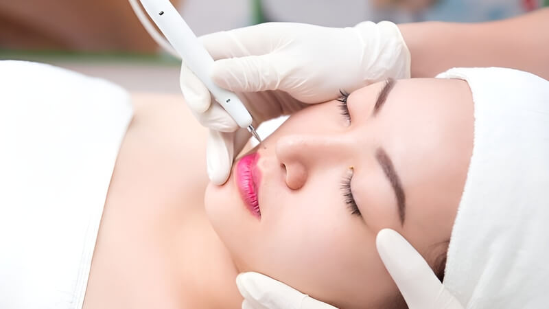 Nên tẩy nốt ruồi ở môi trên nếu nó gây mất thẩm mỹ cho khuôn mặt