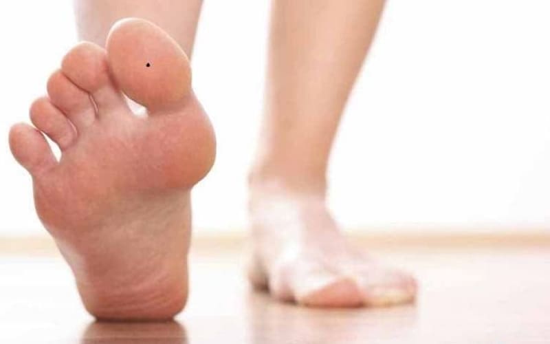 Nốt ruồi ngón chân cái