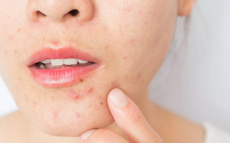 Ăn bánh gạo nổi mụn không?