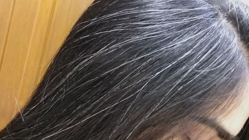 Thiếu máu cản trở sản sinh melanin, khiến tóc mất màu tự nhiên