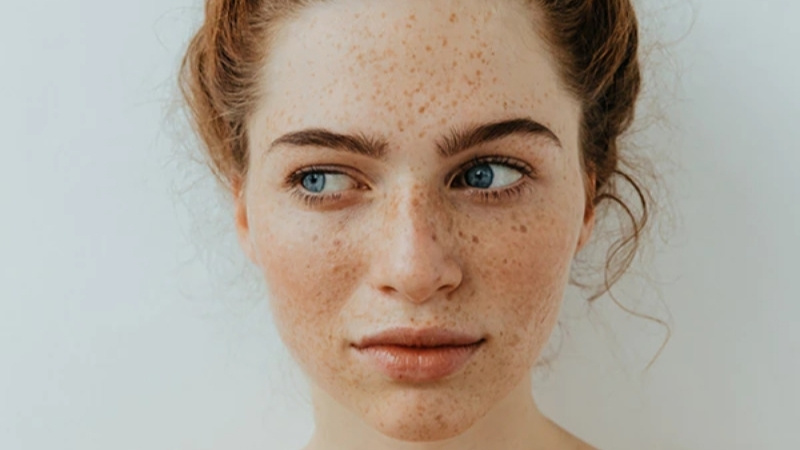 Da bị nám và tàn nhang do tích tụ melanin
