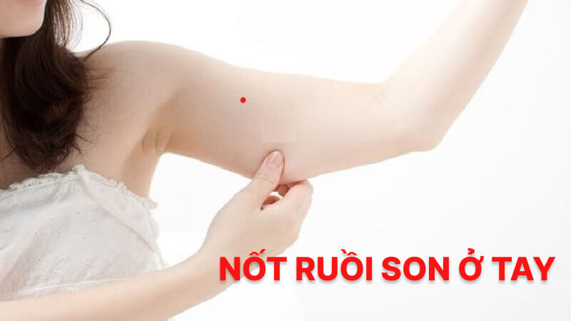 Nốt ruồi son ở cánh tay Nốt ruồi son ở cánh tay