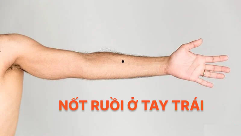 Nốt ruồi ở tay trái Nốt ruồi ở tay trái