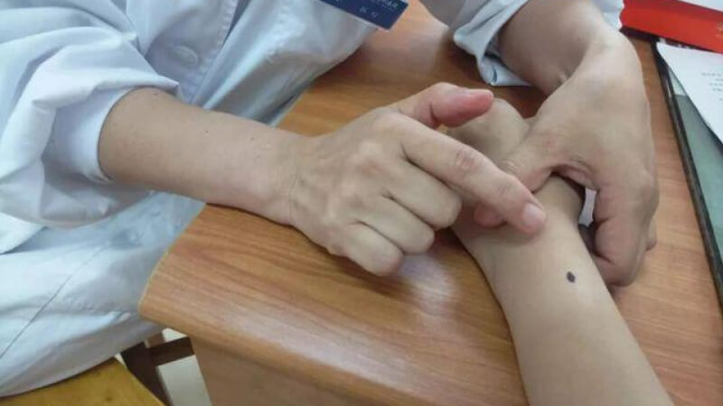 Có nên tẩy nốt ruồi ở cánh tay Có nên tẩy nốt ruồi ở cánh tay