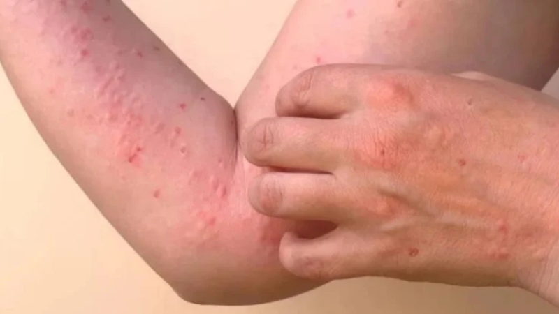 Các triệu chứng của bệnh Chikungunya