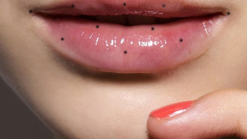 Nốt ruồi son ở khóe miệng