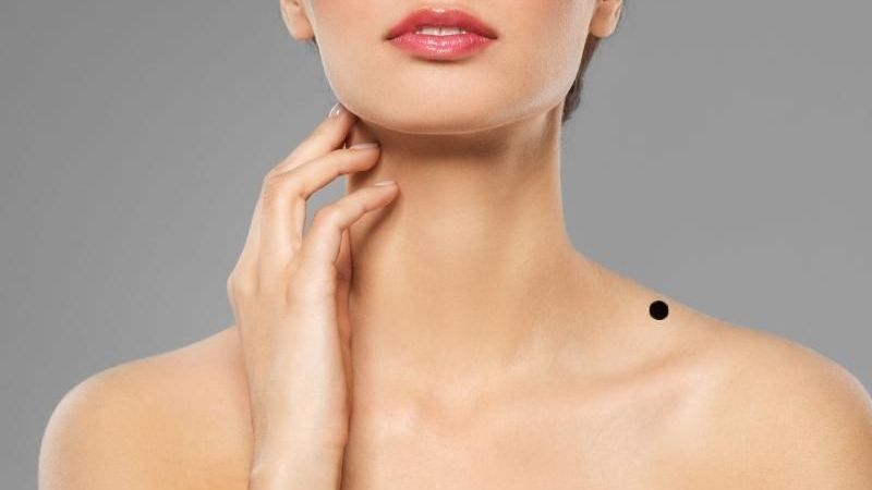 Nốt Ruồi Trên Vai