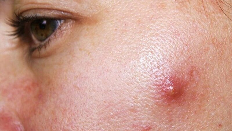 Một số bệnh lý cần kiêng cay để tránh làm bệnh nặng thêm hoặc chậm hồi phục