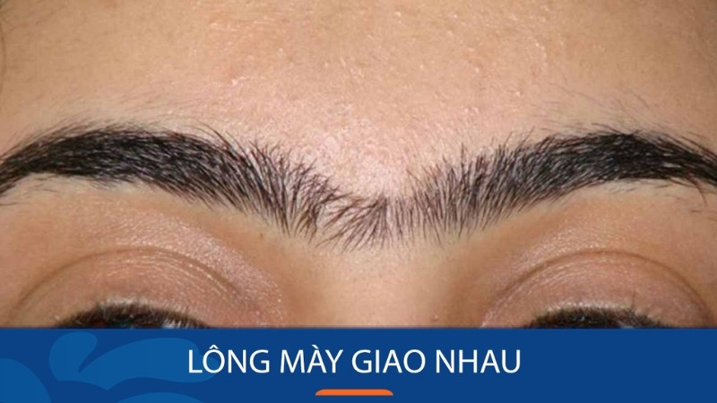 Lông mày giao nhau thường che lấp ấn đường, biểu hiện tính cách bảo thủ