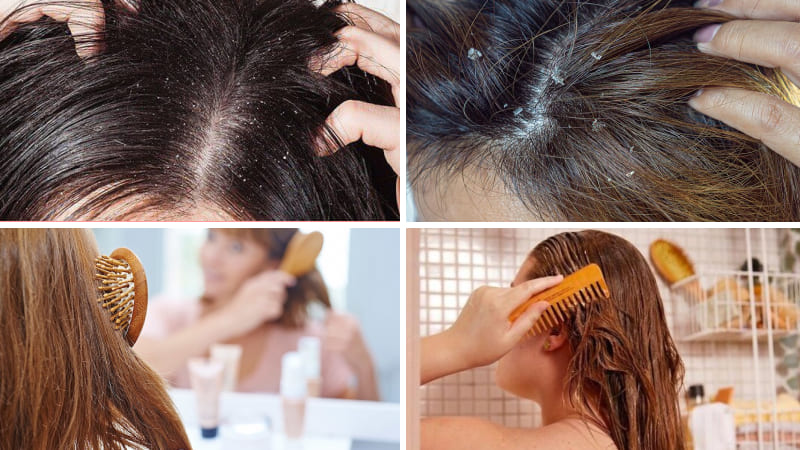 “Thủ phạm” nào gây ra mụn trên da đầu?