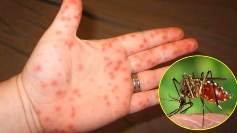 Vì sao sau mưa lũ dễ bùng phát sốt xuất huyết? Vì sao sau mưa lũ dễ bùng phát sốt xuất huyết?