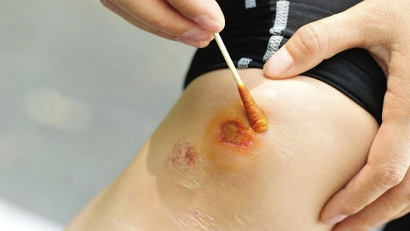 Bạn cần chuẩn bị oxy già và cồn y tế để rửa vết thương