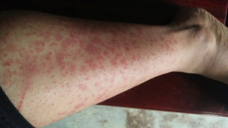 Thuốc kháng histamin thế hệ 2 rất hiệu quả cho người bị dị ứng