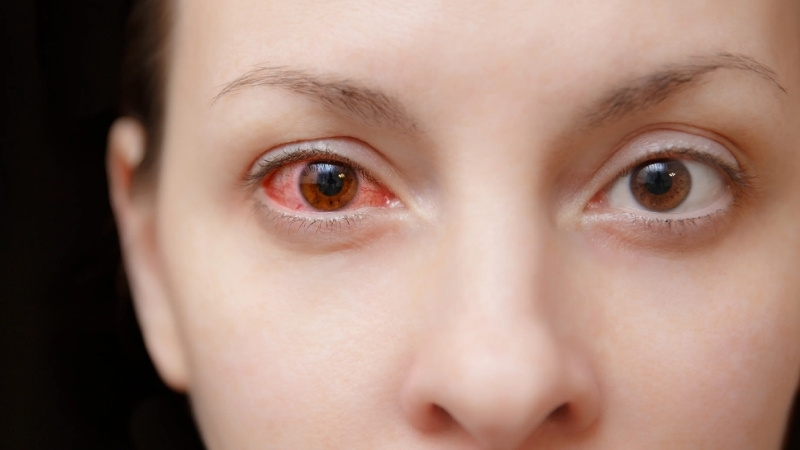 Chuẩn bị nước muối sinh lý hoặc thuốc nhỏ mắt kháng khuẩn nhẹ để rửa mắt