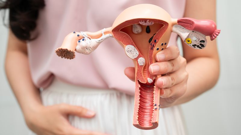 U xơ tử cung và polyp tử cung là khối u lành tính phát triển trong hoặc trên thành tử cung