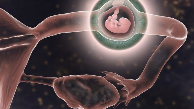 Thai ngoài tử cung là tình trạng trứng đã thụ tinh làm tổ bên ngoài tử cung