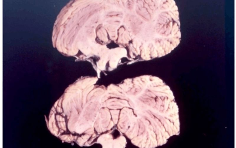 Kuru chỉ lây khi tiếp xúc trực tiếp với mô não nhiễm prion Kuru chỉ lây khi tiếp xúc trực tiếp với mô não nhiễm prion