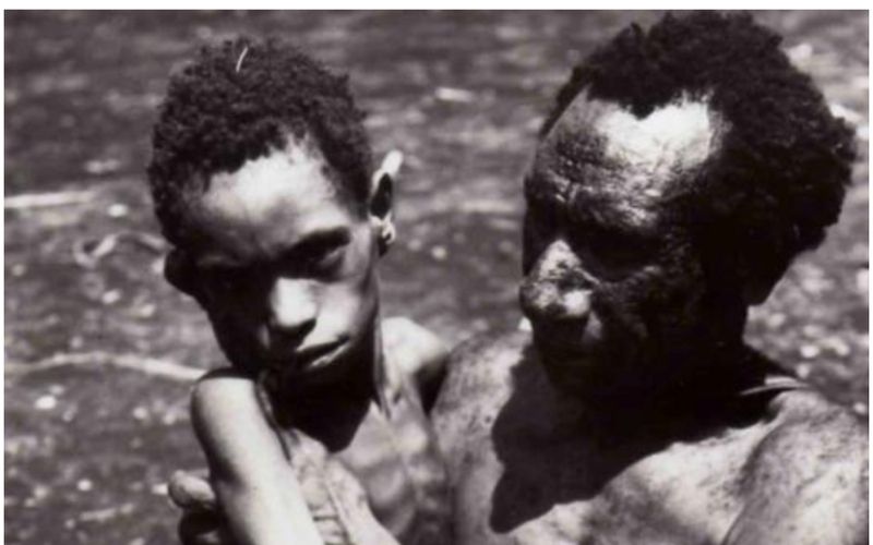 Triệu chứng của Kuru tiến triển theo ba giai đoạn, từ run rẩy nhẹ đến liệt giường và tử vong Triệu chứng của Kuru tiến triển theo ba giai đoạn, từ run rẩy nhẹ đến liệt giường và tử vong