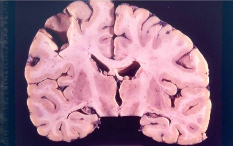 Prion bất thường trong mô não người là nguyên nhân trực tiếp gây bệnh Kuru Prion bất thường trong mô não người là nguyên nhân trực tiếp gây bệnh Kuru