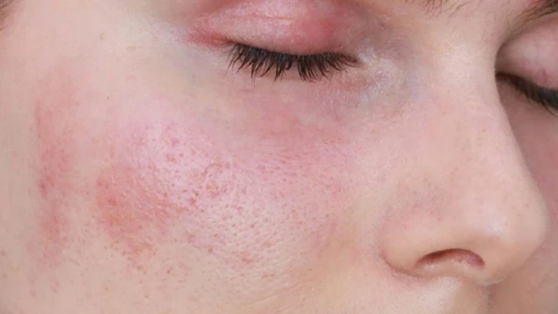 Da bị khô căng Da bị khô căng