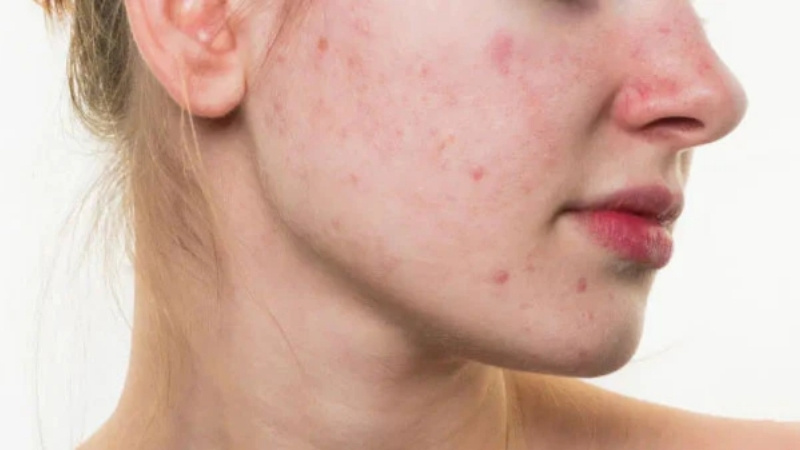 Da hỗn hợp vào mùa đông Da hỗn hợp vào mùa đông