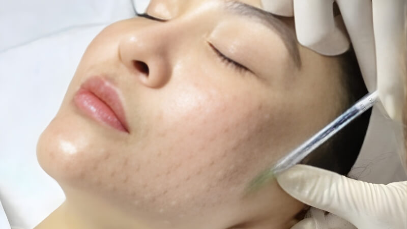 Cocktail meso trị nám, làm sáng da