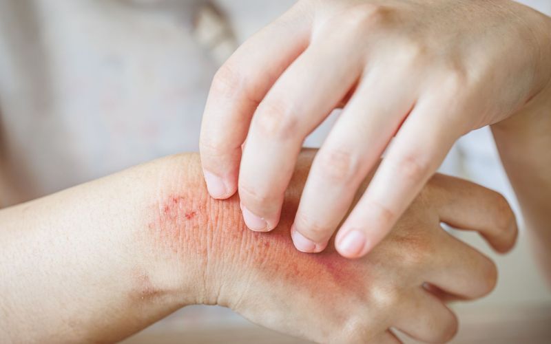 Dị ứng hải sản thường tái phát khi tiếp xúc lại thực phẩm gây dị ứng