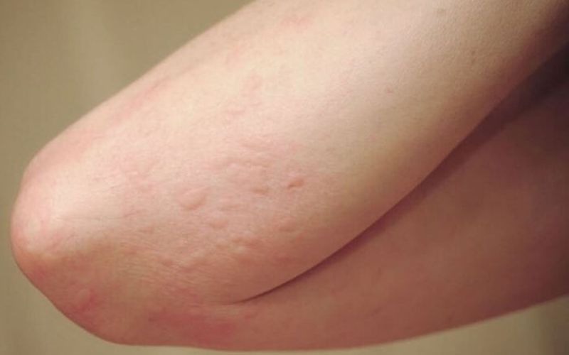 Dị ứng hải sản có thể xuất hiện nhanh và mức độ khác nhau