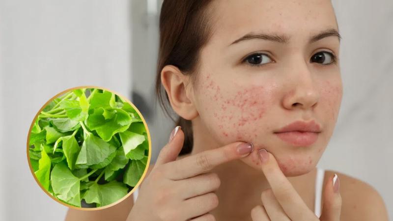 Rau má có tác dụng gì trong trị mụn?
