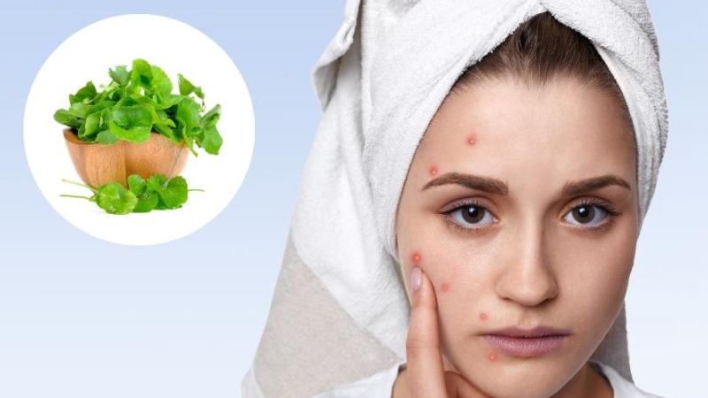 Trị mụn bằng rau má