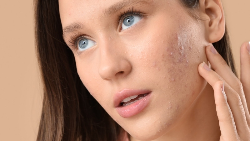 Người da quá nhạy cảm, mụn viêm nặng hoặc dị ứng Vitamin B3 không nên dùng Olay