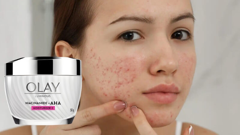Kem Olay có trị mụn không? Sự thật từ chuyên gia da liễu