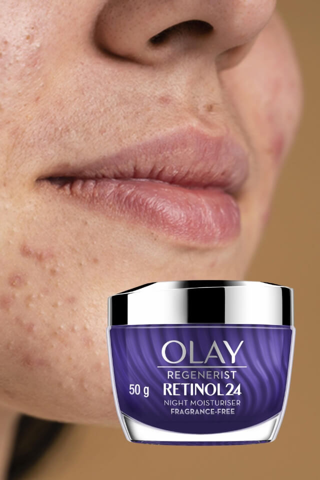 Kem Olay có trị mụn không? Review 3 dòng ngừa mụn mờ thâm