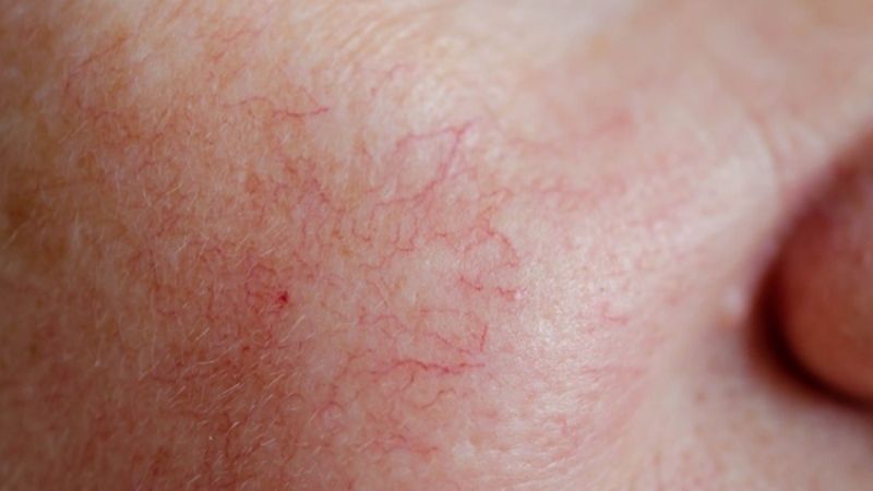 Da mỏng, dễ lộ vân máu, đỏ rát và thường xuyên châm chích khi dùng mỹ phẩm